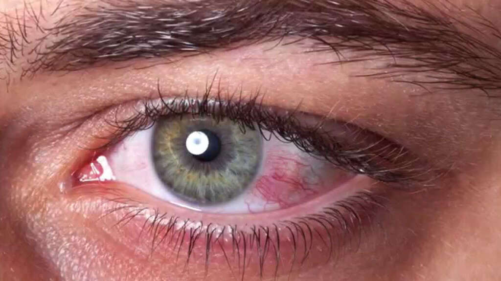 Blepharitis