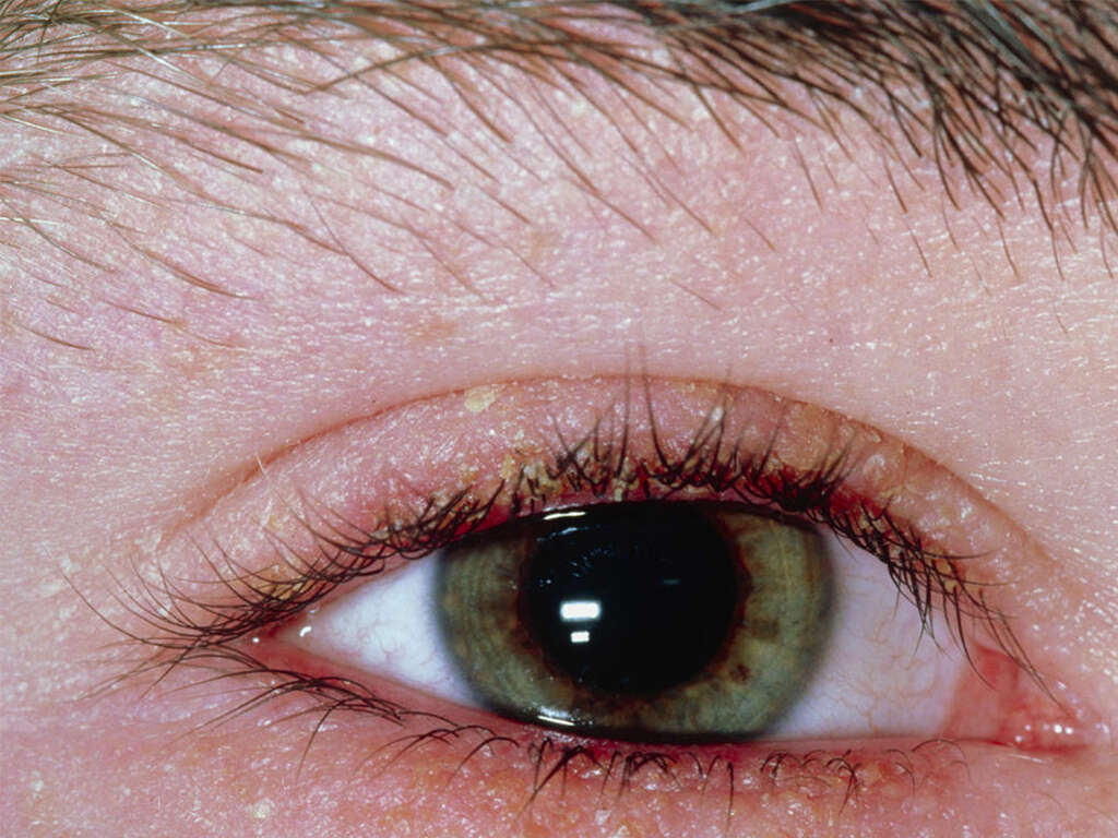 Blepharitis