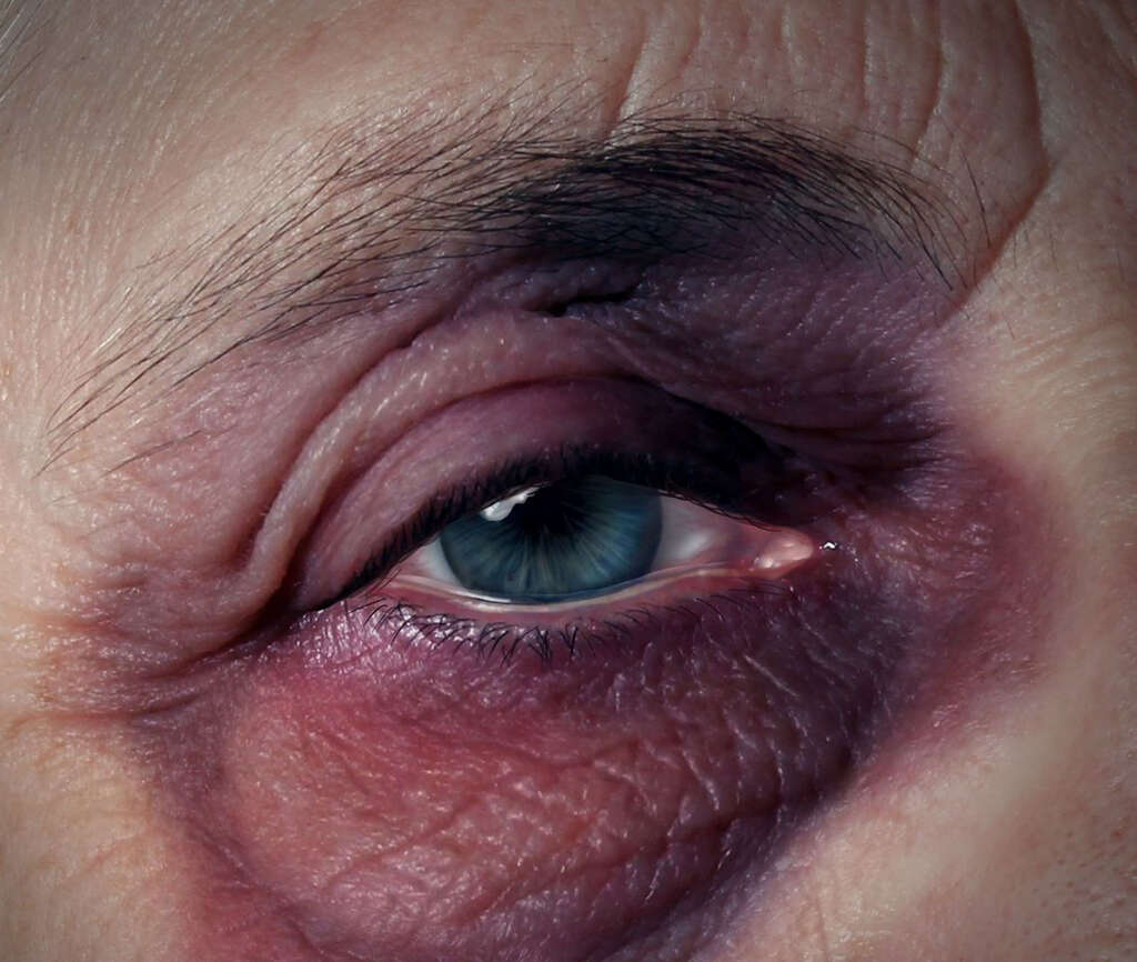 Blepharitis