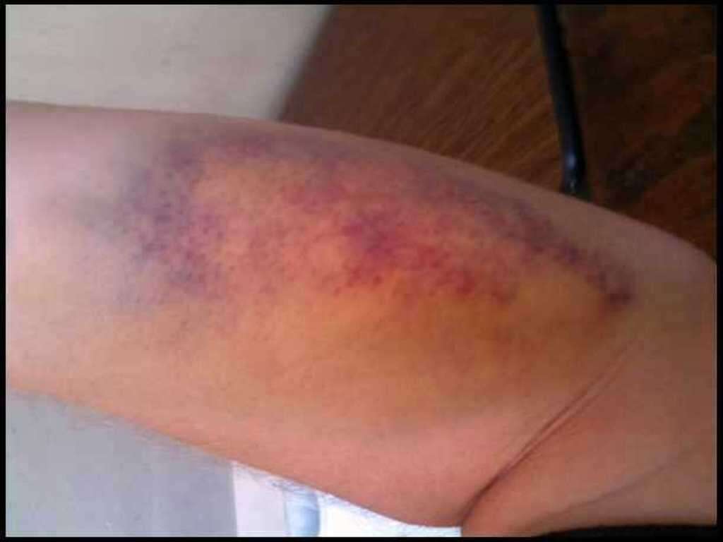 Blood Clot