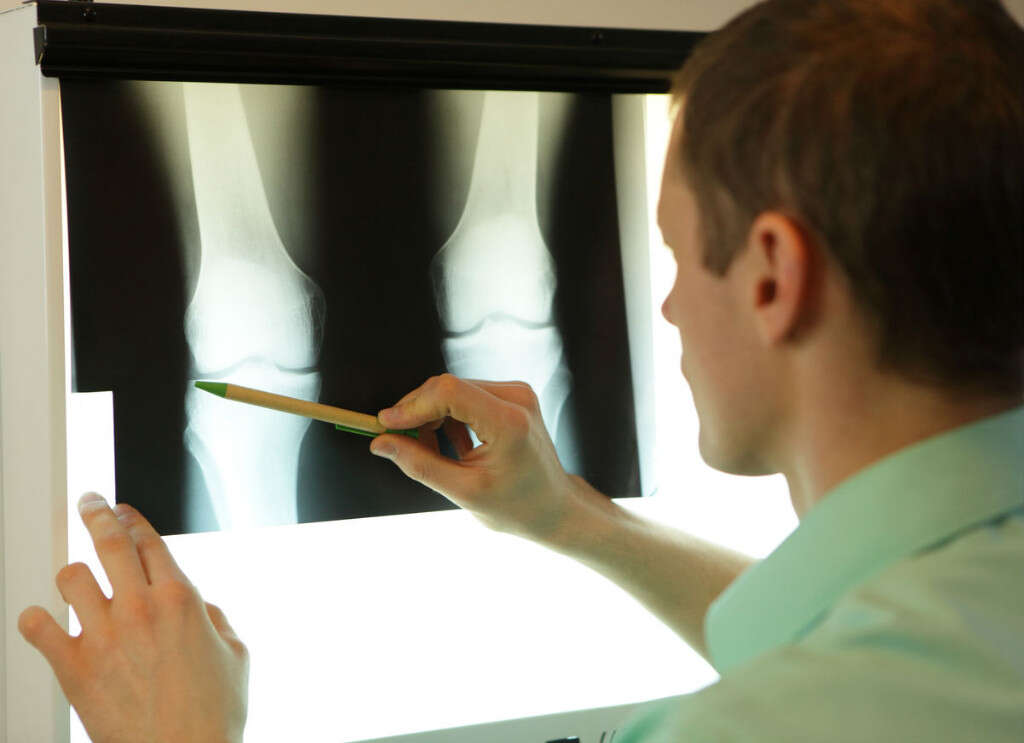 Bone Fracture