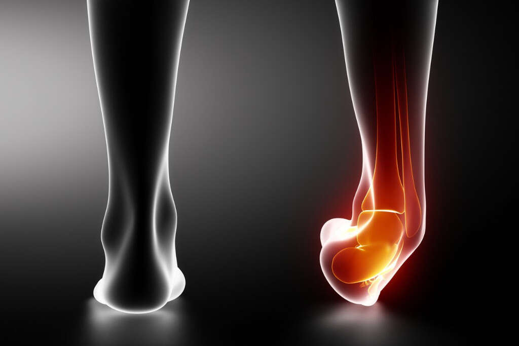 Broken Ankle