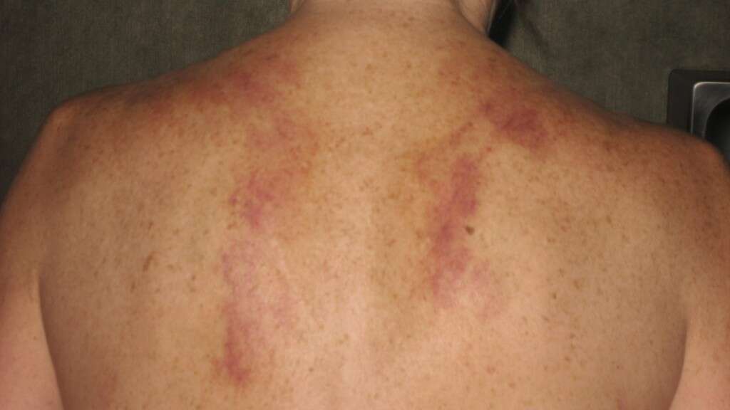 Broken Collar Bone
