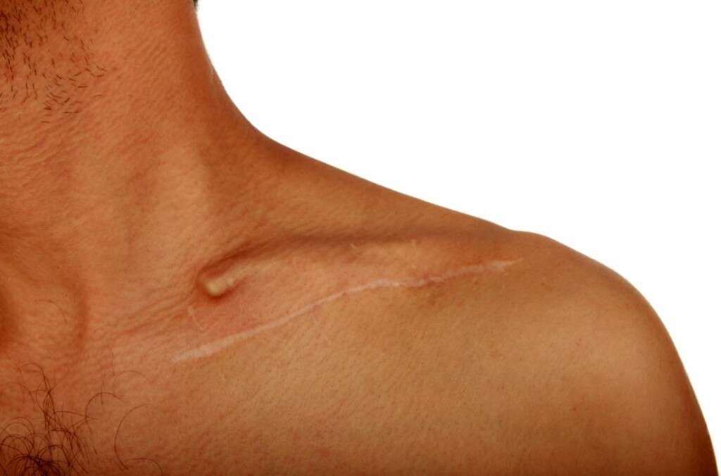 Broken Collar Bone