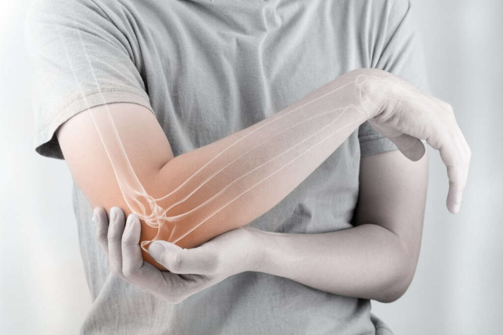 Broken Elbow