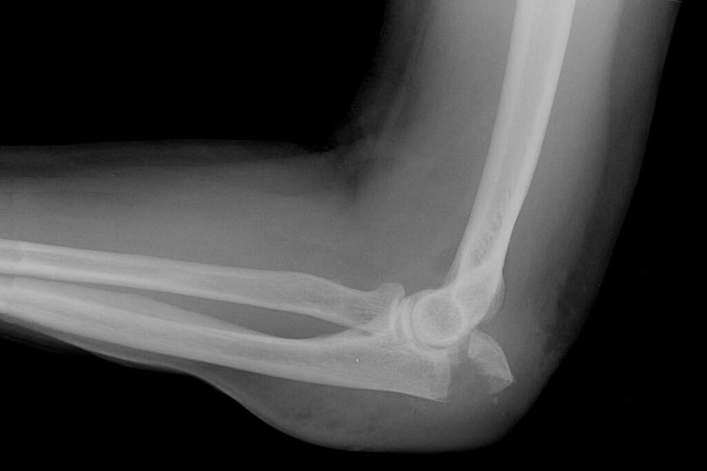 Broken Elbow