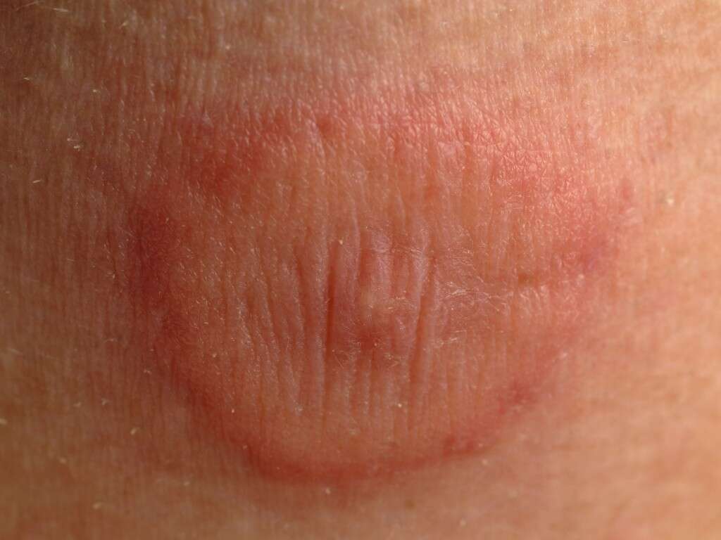 Bursitis