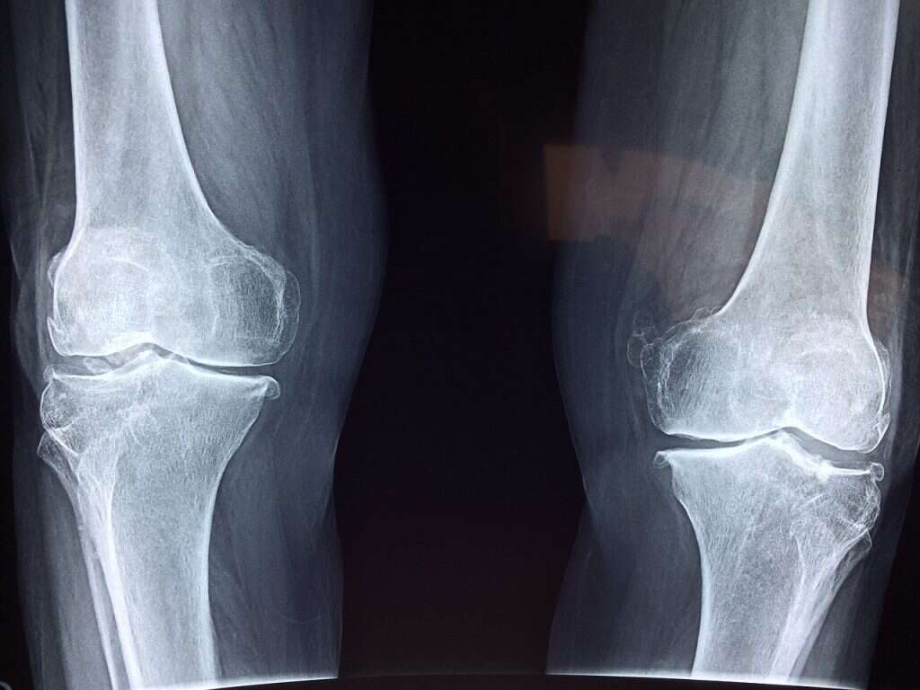 Bursitis