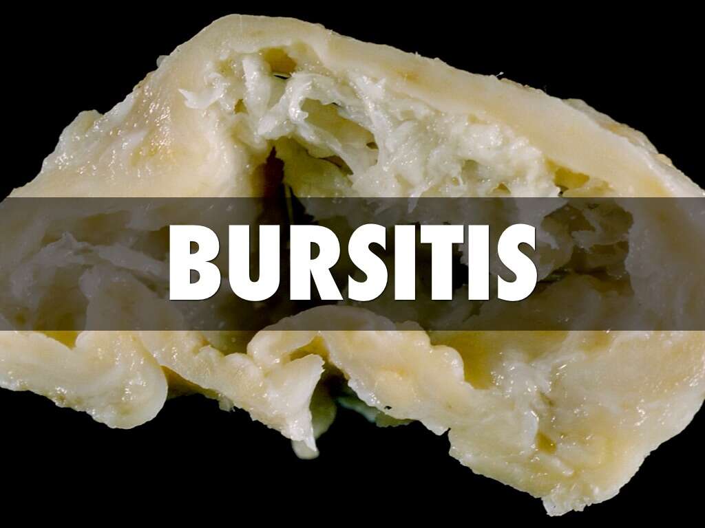 Bursitis