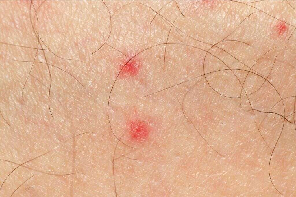 Calcium Deficiency