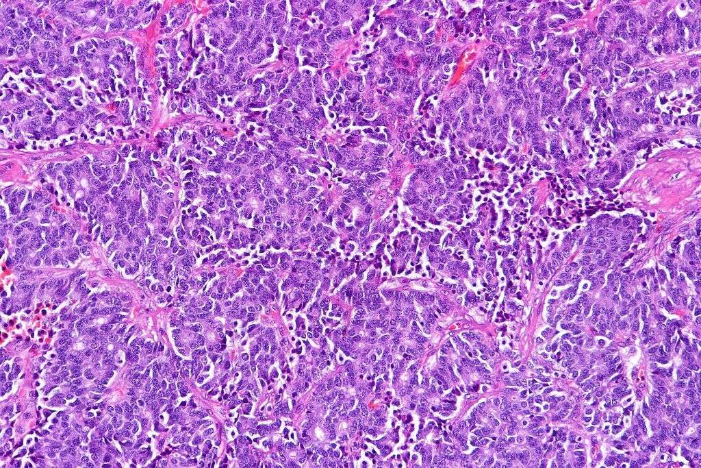 Carcinoid Syndrome