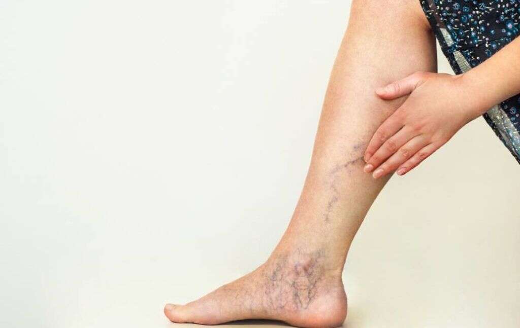 Carcinoid Syndrome