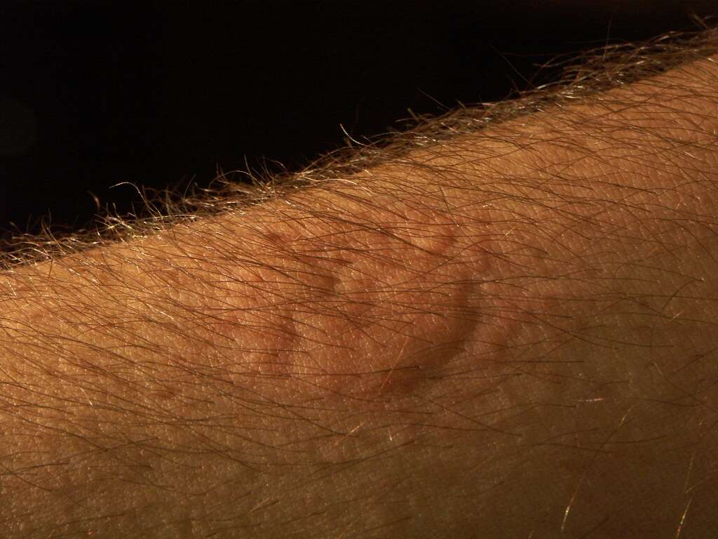 Cat Scratch Disease