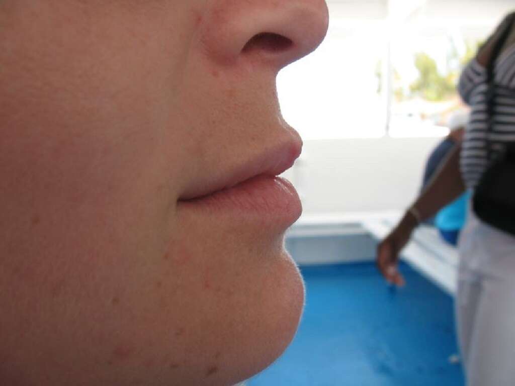Sores In Nose