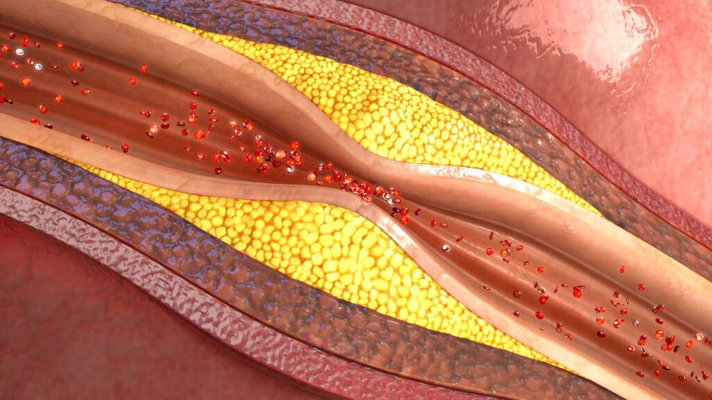 Brain Aneurysm
