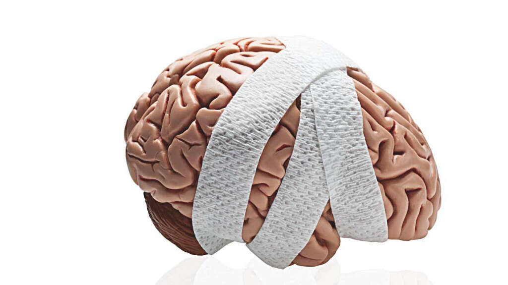 Brain Aneurysm