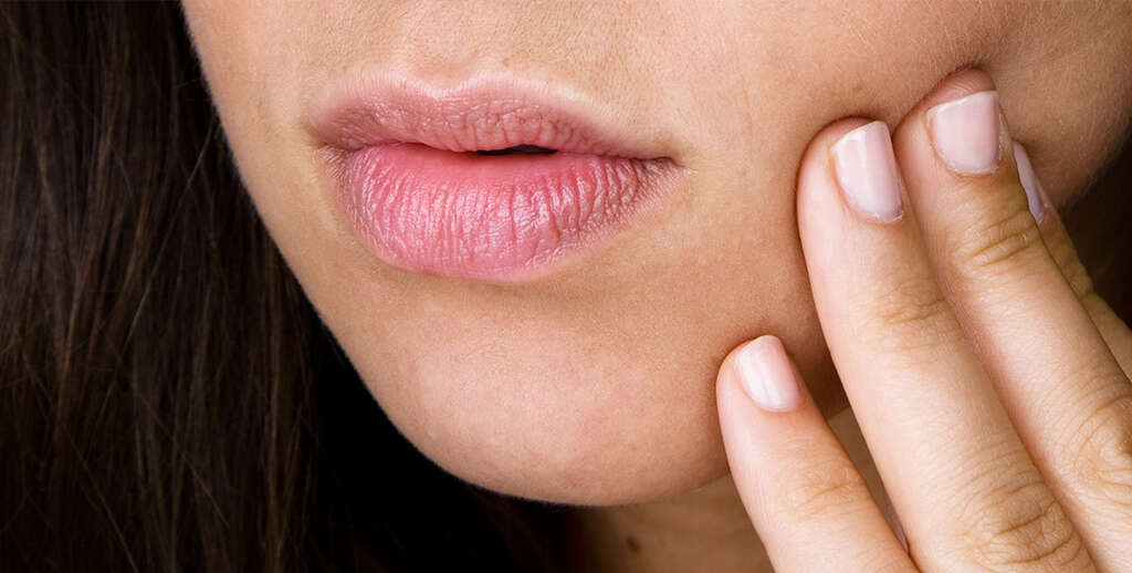 Canker Sores