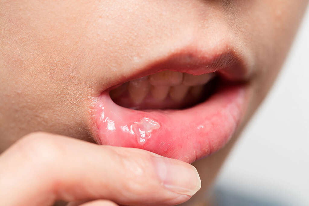Canker Sores