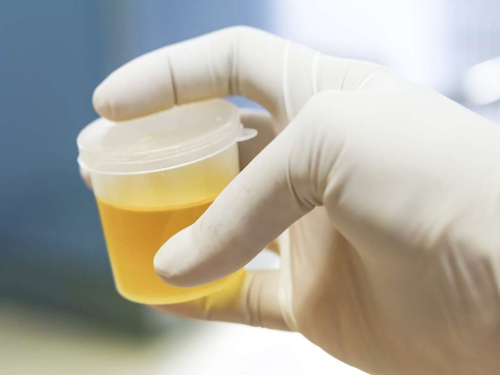 Cloudy Urine