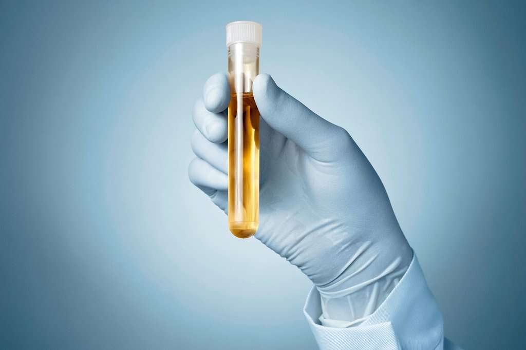 Dark Urine
