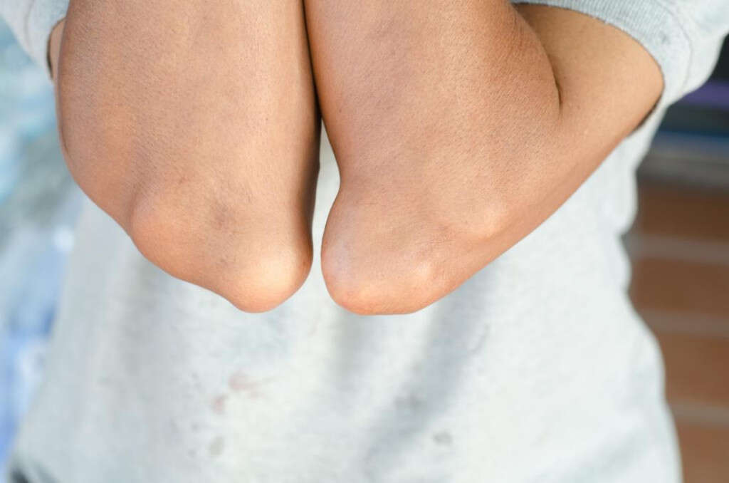 Elbow Pain