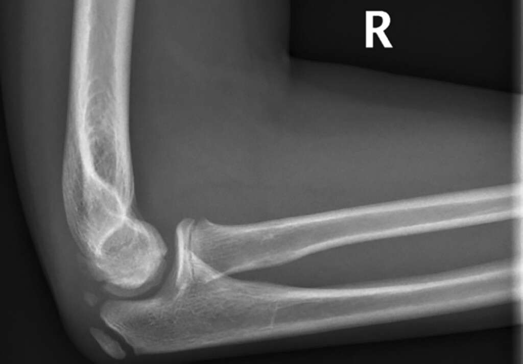 Elbow Pain