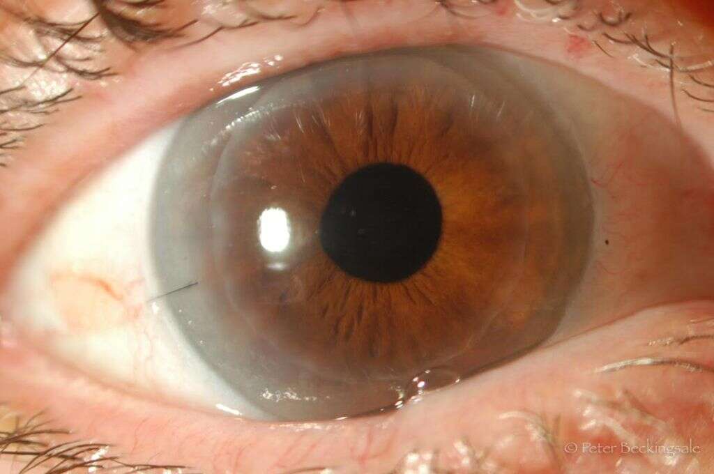 Glaucoma