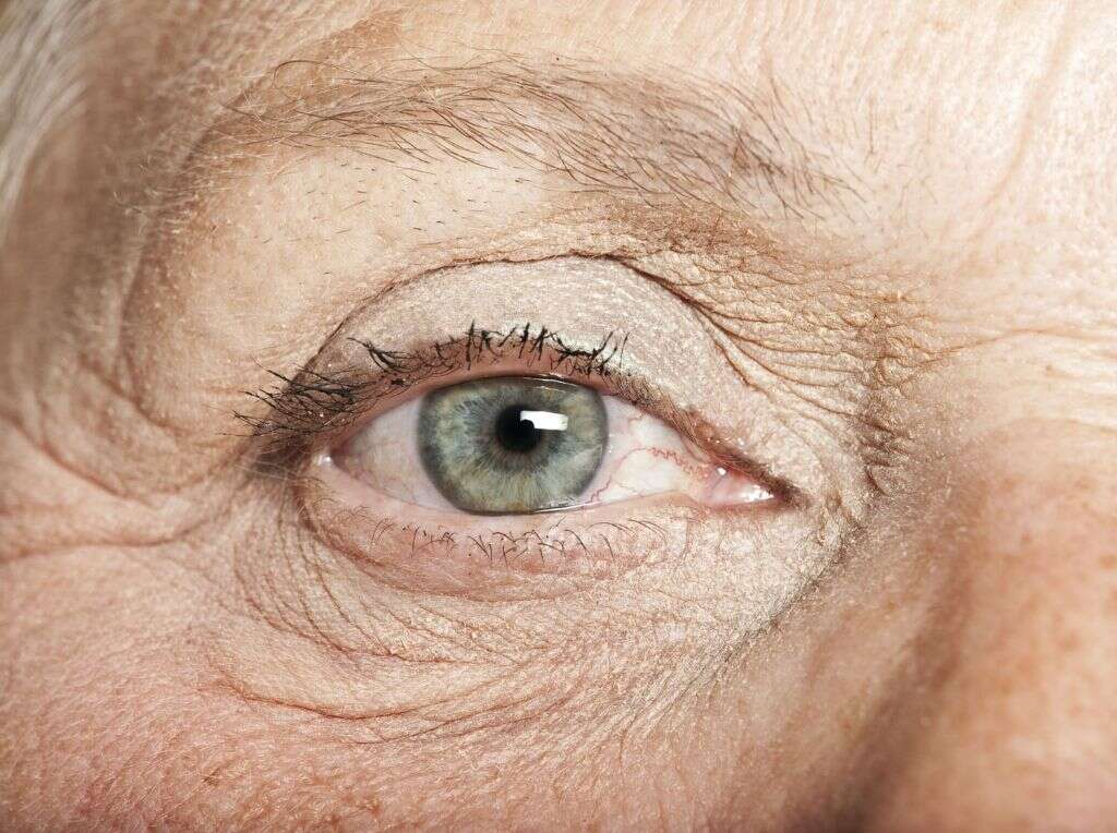 Glaucoma