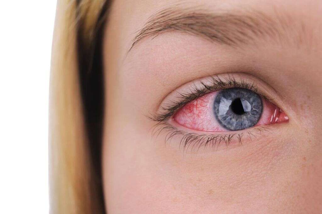 Glaucoma