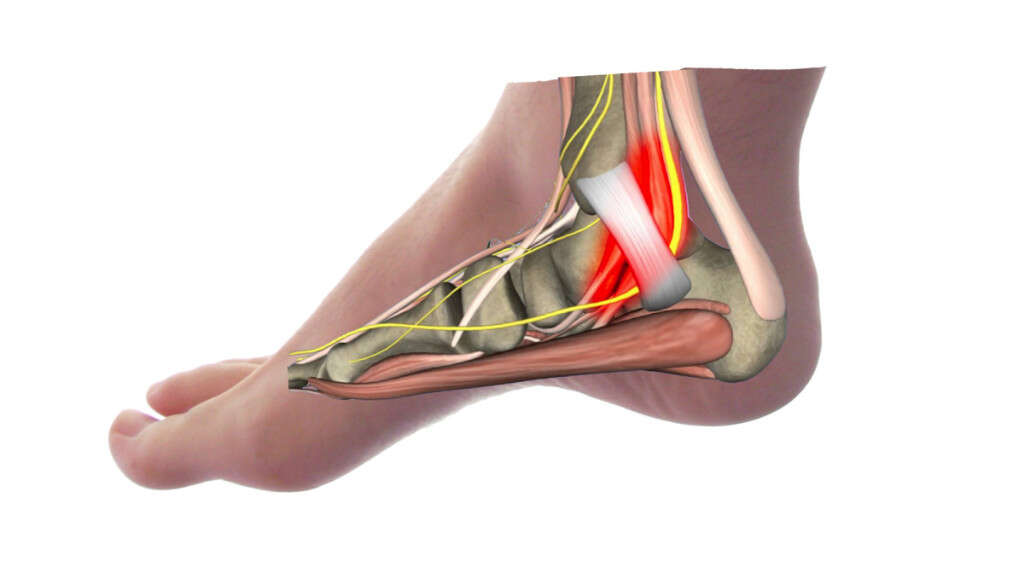 Heel Pain