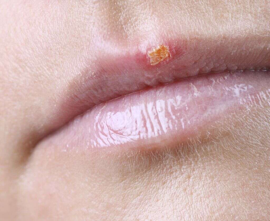 Inflamed Tonsils