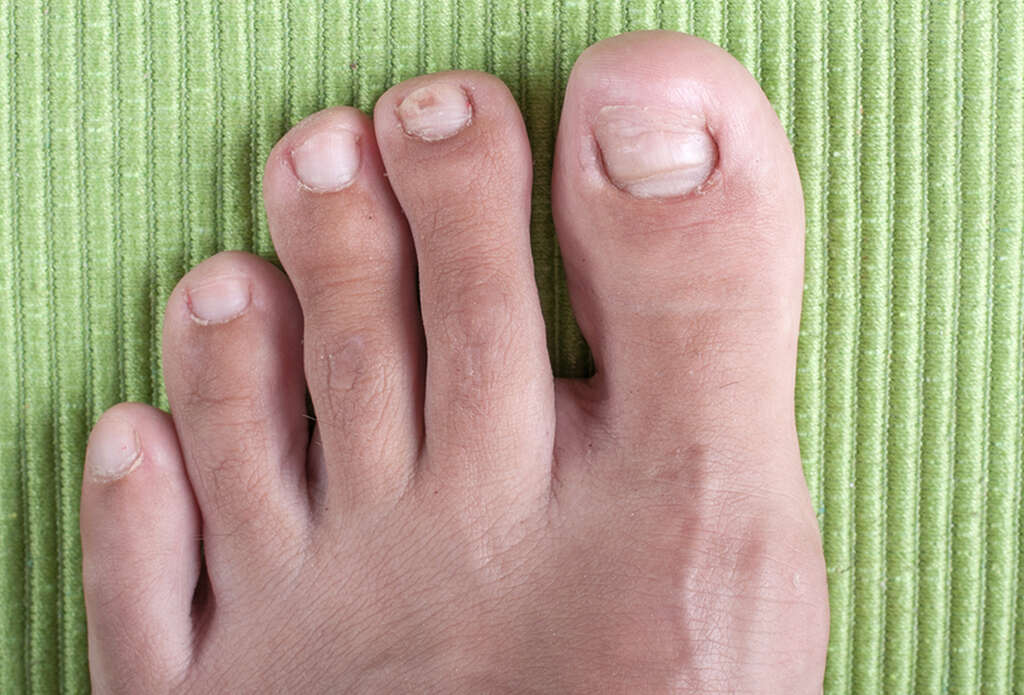 Ingrown Toenails