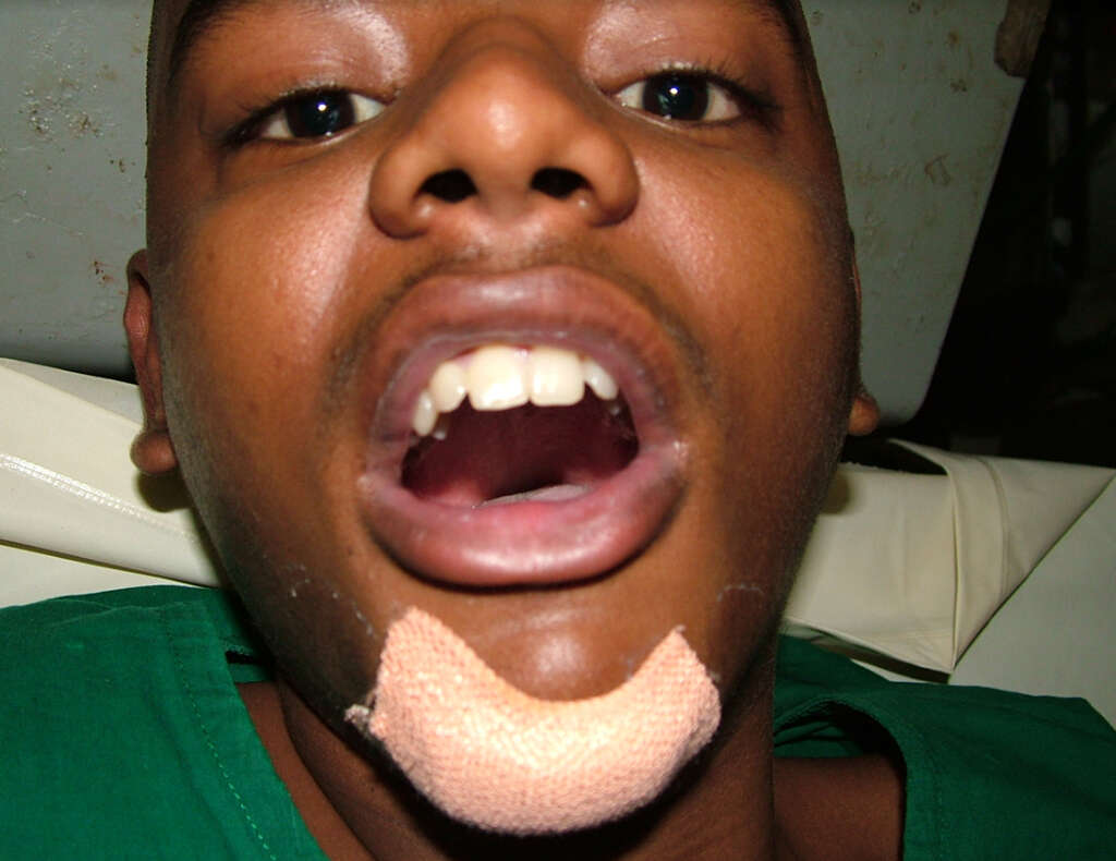 Jaw Pain