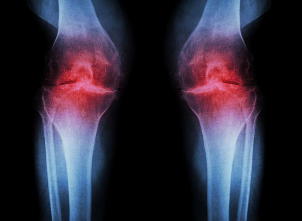 Joint Pain