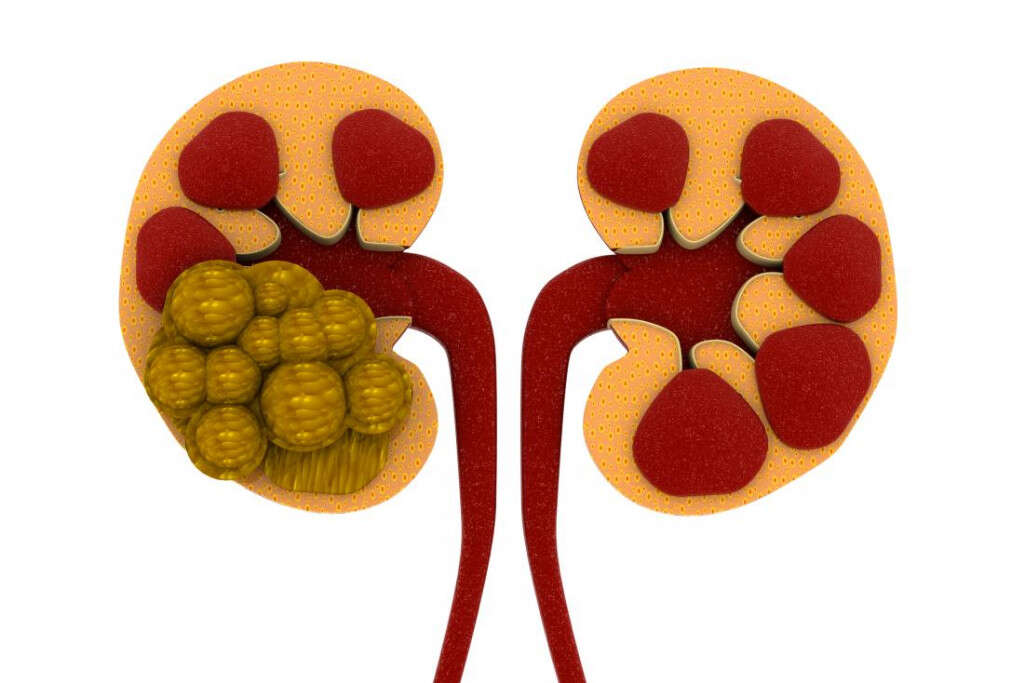 Kidney Pain