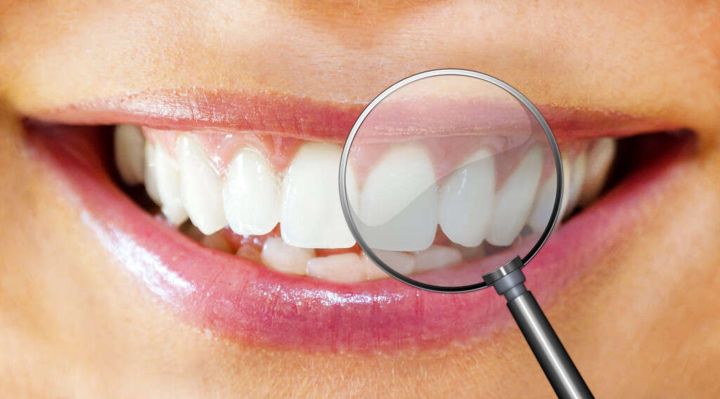 Mouth Ulcers