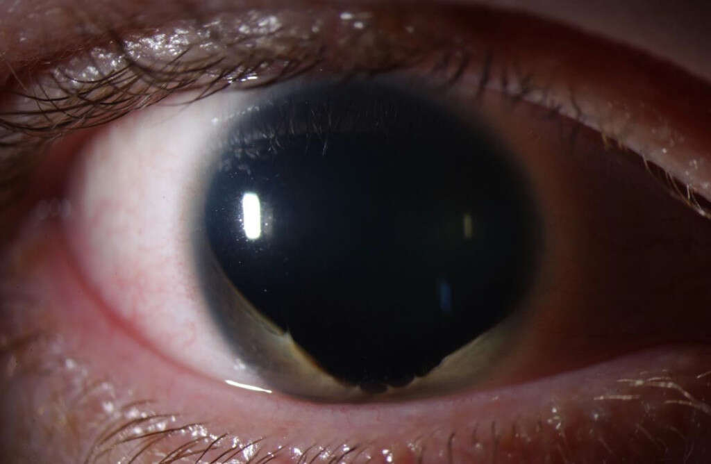 Nystagmus