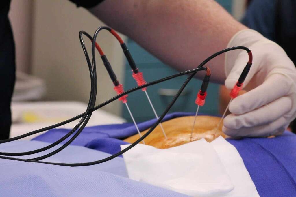 Occipital Neuralgia