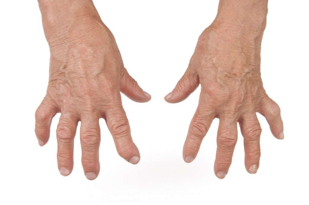 Occipital Neuralgia