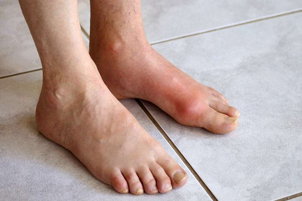 Occipital Neuralgia