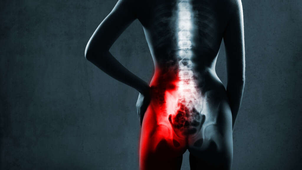 Sciatica