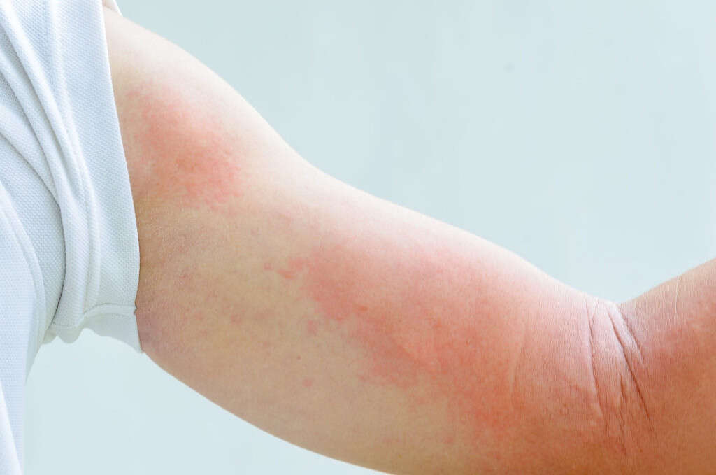 what causes rashes