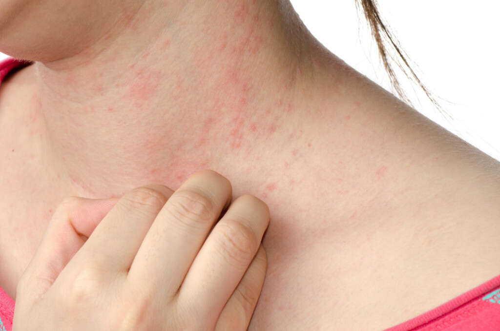 Skin Rash 10 Causes Of Skin Rashes