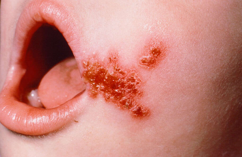 Skin Rash