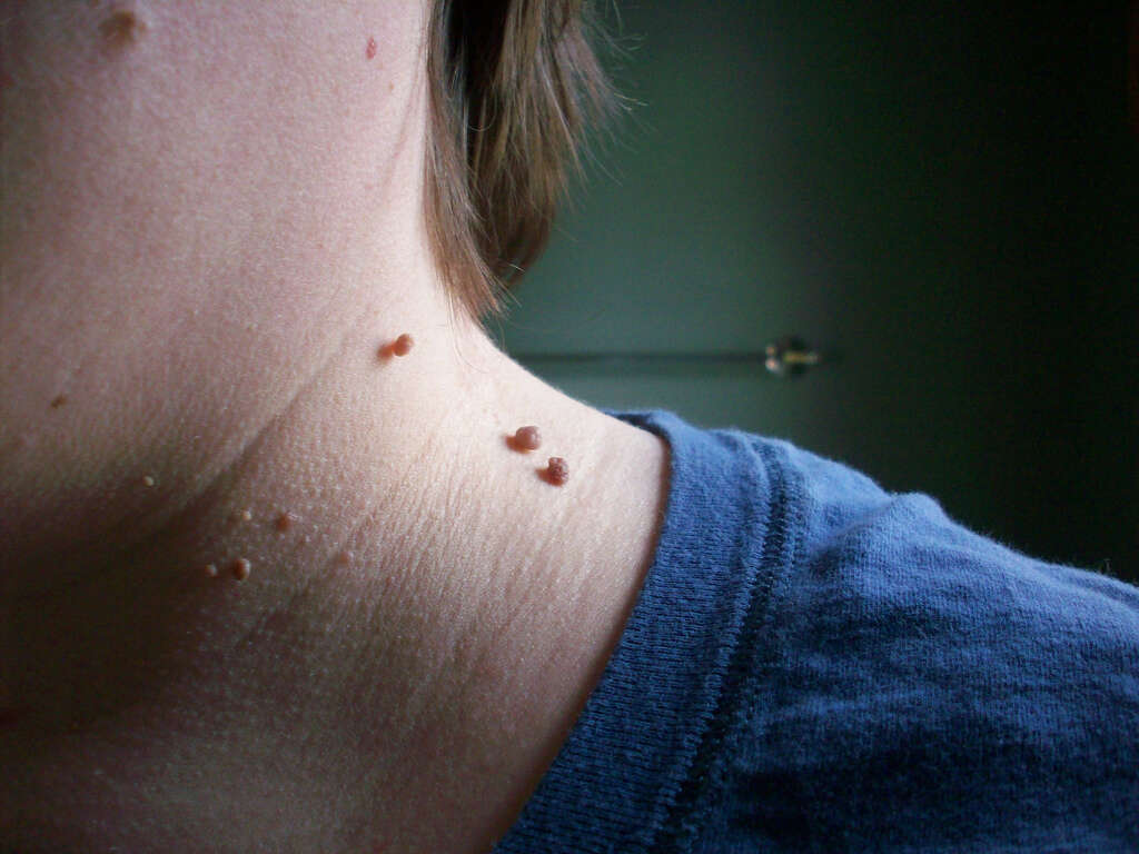 Skin Tags