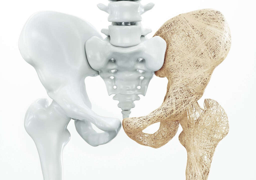Spinal Stenosis
