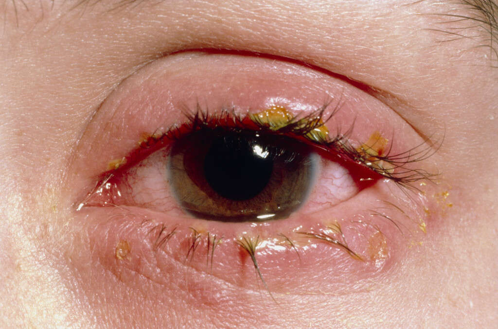 Stye On Eye