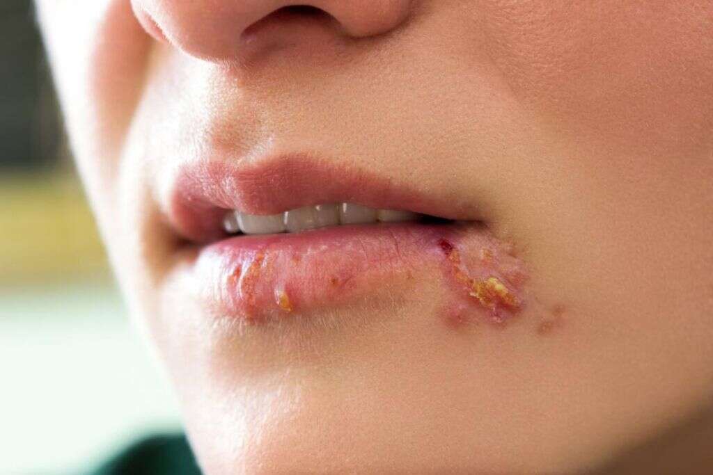 Swollen Tonsils