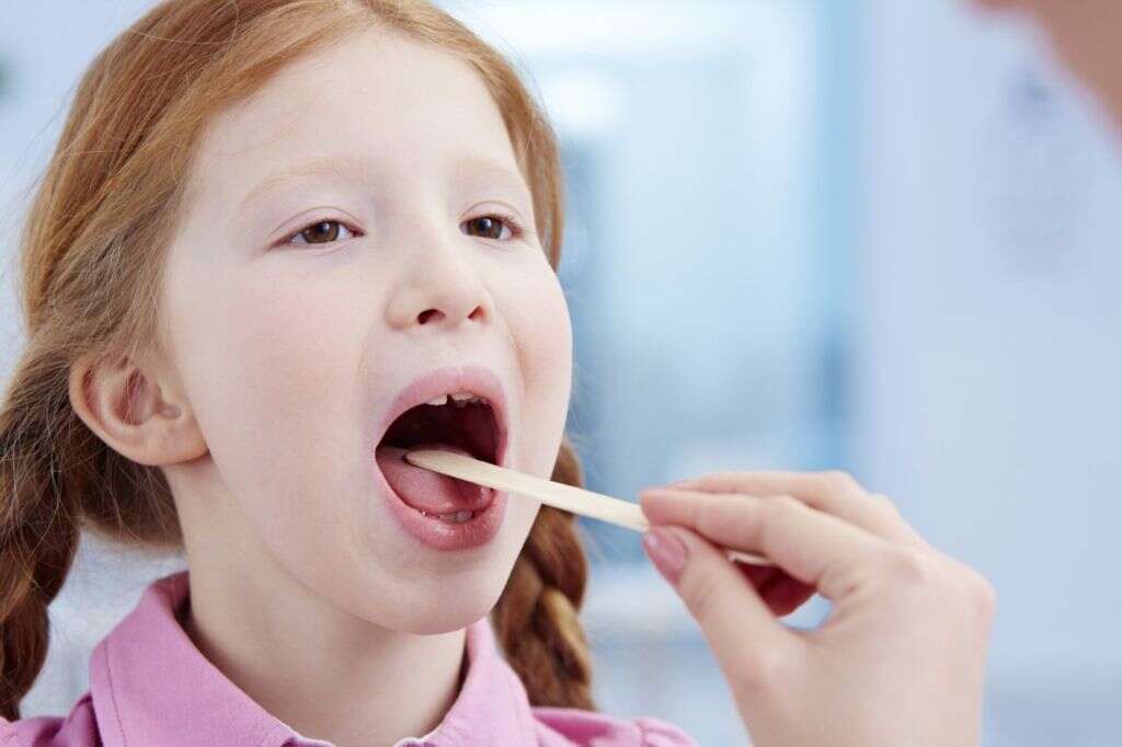 Tonsil Stones