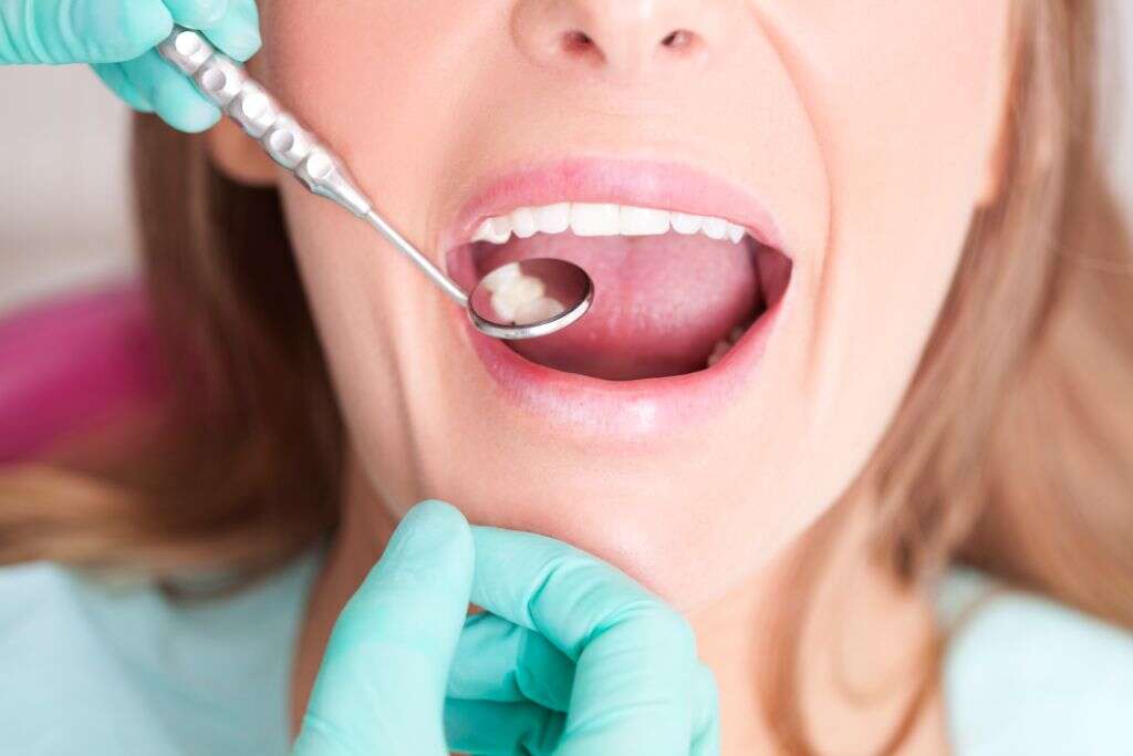 Tonsil Stones